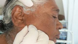 Curtain Sign - Parotid Swelling