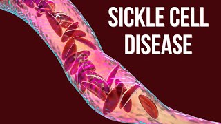 Sickle Cell Disease: Causes, pathophysiology \u0026 Treatment (clinical essential)