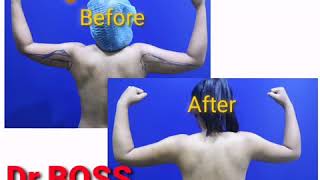 หลังทำ 1 สัปดาห์ ดูดไขมันแขน​ เจ็บไหม คุณฟ้า​ โดยหมอบอส  Liposuction Thailand