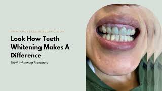 Isabel Teeth Whitening | Angela Leung DDS PC