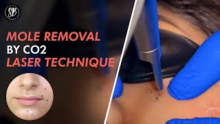 Mole Removal By CO2 Laser | Live procedure by Dr. Shilpi Bhadani | Best Cosmetic Surgeon in Gurgaon