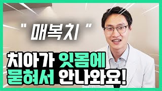 치아가 잇몸에 묻혀서 안 나와요! (매복치 Ver.1)