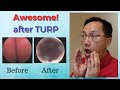 Michael's Prostate Urination Problem & TURP Journey. BPH. Urologist