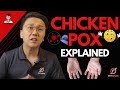 Chickenpox | Varicella-zoster Virus Explained