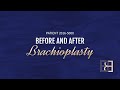 Brachioplasty Including Liposuction {Patient 2016-5000} Before & After