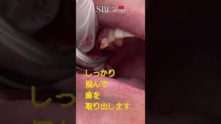 【⚠️閲覧注意⚠️】虫歯で小さくなってしまった奥歯を抜きます。