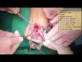 300.(의사용.Surgery.part2. 5) 'Lateral blocking K-wire' on Calcaneal fx. Kang's method [강찬.충남대병원.Chan]