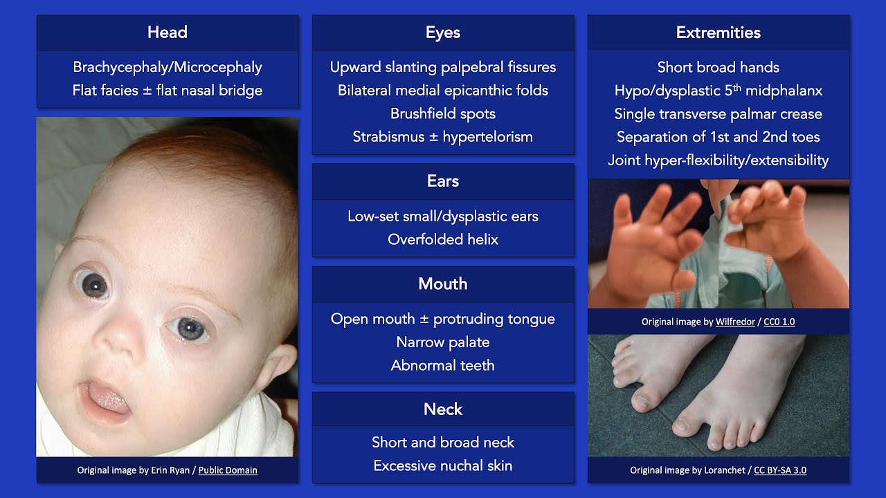 Down Syndrome: Dysmorphic Features - YouTube