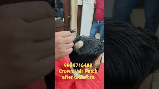 9899746489 Crown Hair Patch Fixing Delhi #viral #video #trending #expert #reel #hairpatch #style