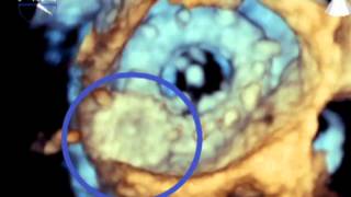 Paravalvular Leak Closure Using Transapical Approach at Holy Cross Hospital, Fort Lauderdale, FL