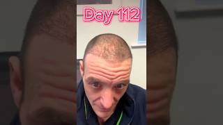 Day 112 Join My Hair Transplant Journey: Real Results \u0026 Recovery