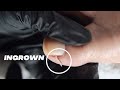 DIY INGROWN TOENAIL PEDICURE AT HOME //  Relaxing Pedicure