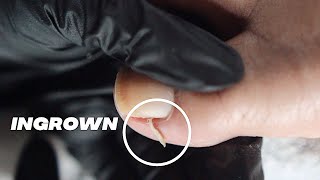 DIY INGROWN TOENAIL PEDICURE AT HOME // Relaxing Pedicure