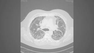 Axial chest high-resolution CT scan in a patient with idiopathic pulmonary fibrosis