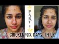 Chickenpox days | Part 1 | UK Vlogs