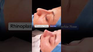 Barbie Nose Rhinoplasty in Istanbul | Dr. Şerif Yavuz 🌟#rhinoplastyturkey #nosejobistanbul