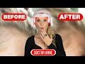 Does the CurrentBody LED Hair Growth Helmet Really Work? Doctor Anne’s 6-Month Review