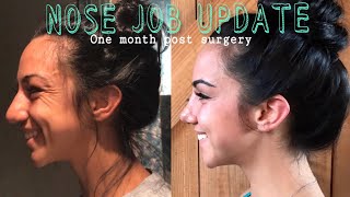 Nose Job || Cast Removal + One Month Update