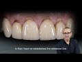 gingival recession treatment video tutorial by dr. otto zuhr