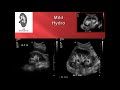 Hydronephrosis Point of Care Ultrasound