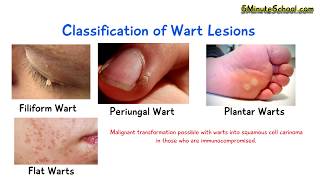 What is a Wart? (Human Papilloma Virus) EXPLAINED IN 3 MINUTES! Cause Diagnosis CLASSIFICATION