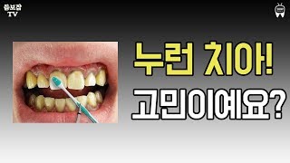 누런 치아가 고민이예요! -2809TV