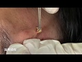 額頭粉瘤、脂囊瘤切除，美麗新城診所莊禮謙醫師 Face Epidermal Cyst, Steatocystoma, Dr George