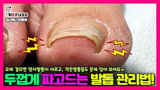 오래 걸으면 욱씬욱씬 아프다? 두껍게 파고드는 발톱 관리하는 법!! 작은 발톱들까지^^ 깔끔하게 #레푸스 #레푸스일산 #내성발톱 #무좀발톱 #ingrown_toenail