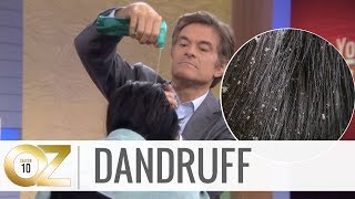 Quick and Easy Home Remedies For Dandruff
