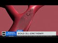 FDA approves CRISPR gene-editing therapy for sickle cell treatment