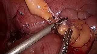 Bilateral Salpingectomy with Appendicectomy - Dr R K Mishra