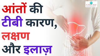 आंतों की टीबी कारण, लक्षण और इलाज़ || | Abdominal tuberculosis || Dr. Zubin Dev Sharma