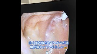 【Bスポット治療】病院変えて強めに擦ったら衝撃・・・EAT治療【慢性上咽頭炎】