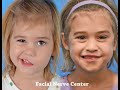 SMILE REANIMATION | Before & After 1