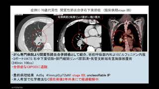 【肺がん治療②手術】呼吸器外科の専門医が解説します