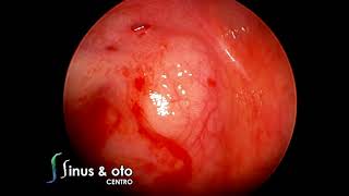 Odontogenic Cyst - Endoscopic Modified Denker's Approach