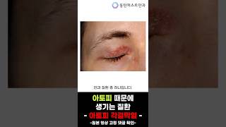 [쇼츠] 눈에 생기는 아토피 질환 - 아토피 각결막염