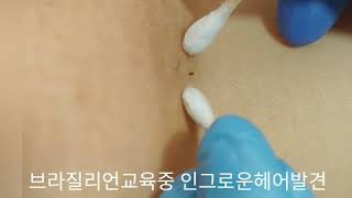 왁싱교육, 인그로운헤어 케어방법 익히기