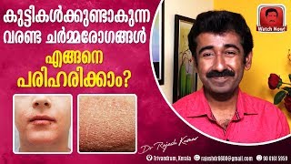 കുട്ടികൾക്കുണ്ടാകുന്ന വരണ്ട ചർമ്മരോഗങ്ങൾ (dry skin diseases) എങ്ങനെ പരിഹരിക്കാം ?