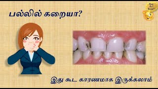 tooth / TOOTh stain / Pal karai / Pallil karaiya? / Pal prachanai / Sothai pal / paal pal / karuppu