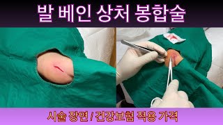 발바닥 베인 상처 봉합술 - 국민건강보험 적용 가격, 꿰매는 장면