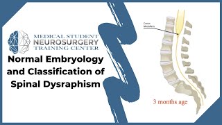 Normal Embryology and Classification of Spinal Dysraphism