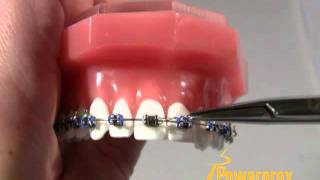 How to Tie a Ligature Tie Powerprox Six Month Braces Orthodontic Education Video