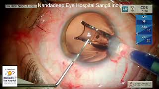 Soft cataract Lift nucleus technique on centurion Dr Sourabh Patwardhan Live Cataract surgery