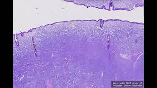 Button tumour or Canine Cutaneous Histiocytoma - Histopathology // Vanessa Herder