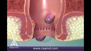 Learn about hemorrhoids with #3d #animation