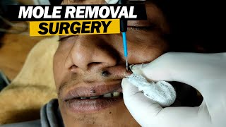 Scarless Mole Removal @dezireclinic