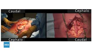 For Surgical First Assist: Posterior Lumbar Laminectomy and Fusion (Cadaveric)