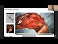 the eans webinar new aspects on aneurysm management