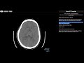 Radiology Walkthroughs - CT Head